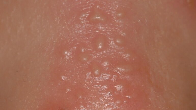 Bläschen bei Herpes zoster II