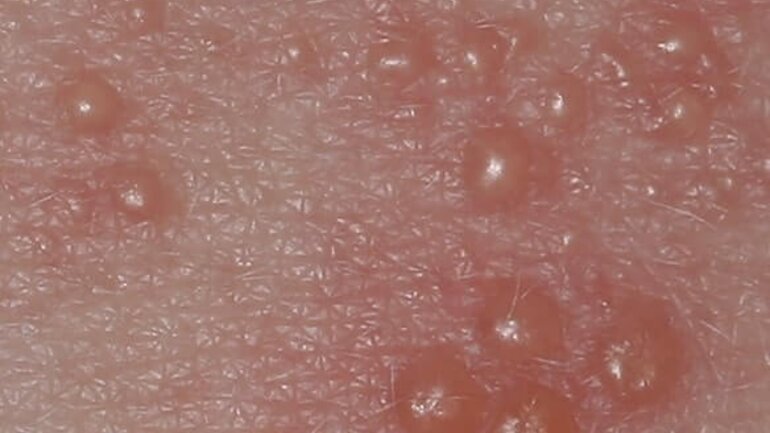 Aussehen von Gürtelrose Herpes zoster (Vesicula intraepidermal)