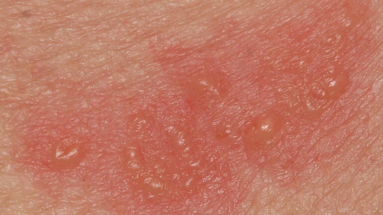 Bläschen bei Hautkrankheit Dermatitis herpetiformis (Morbus Duhring)