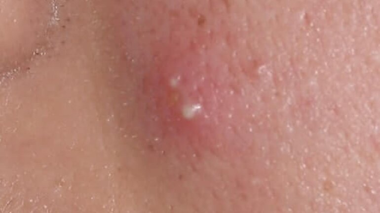 Bild von Haarwurzelentzündung (Follikulitis)