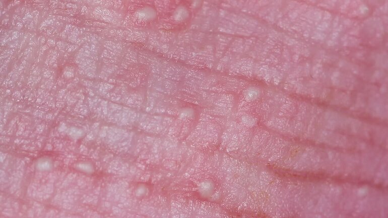 Eiterbläschen bei Erythema toxicum neonatorum