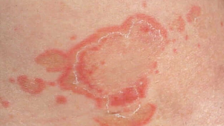 Hautveränderungen bei Erythema anulare centrifugum