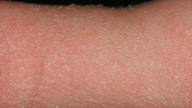 Schuppende, sich ablösende Haut bei Hautkrankheit Ichthyosis