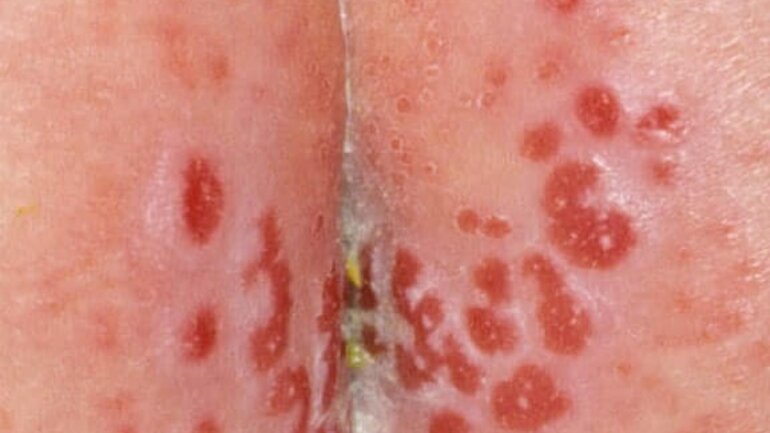 Hautveränderung namens Erosio Windeldermatitis erosiv