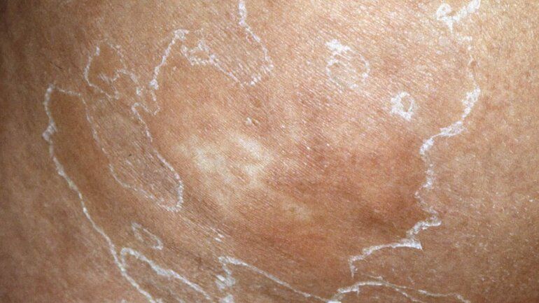 Schuppende Hautveränderungen nach toxischer epidermaler Nekrolyse