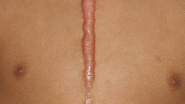 Cicatrix hypertroph (Narbe) nach Thorakotomie