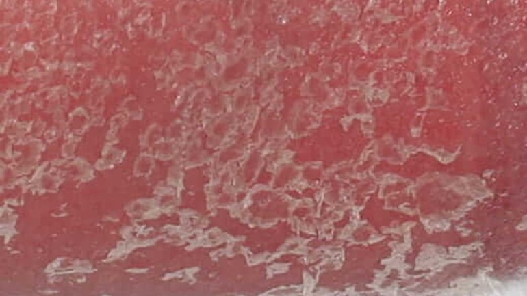 Schuppende Haut bei Besnier-Krankheit (Pityriasis rubra pilaris)