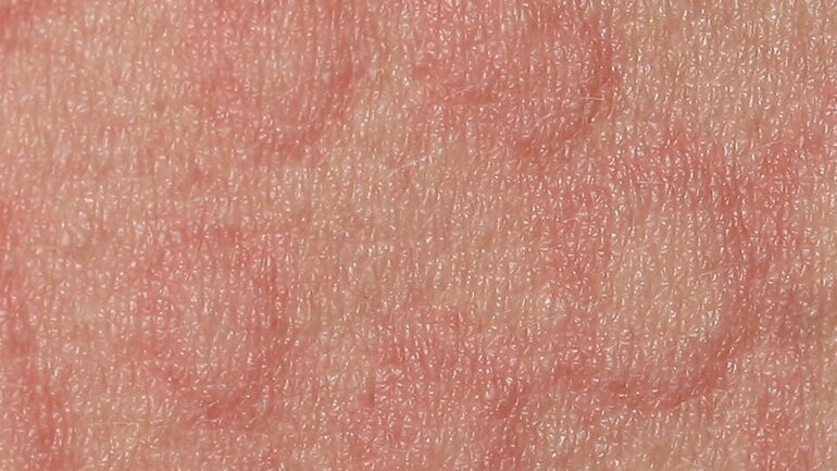 Nesselsucht (Urticaria rubra oder akute Urtikaria)