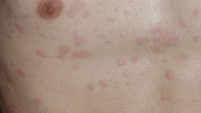 Quaddelbildung bei Nesselsucht (Urticaria rubra)