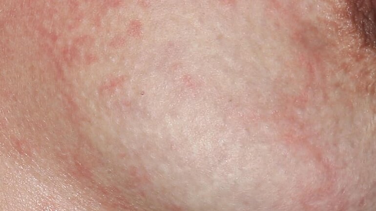 Weißliche Quaddelbildung bei Urticaria porcellanea