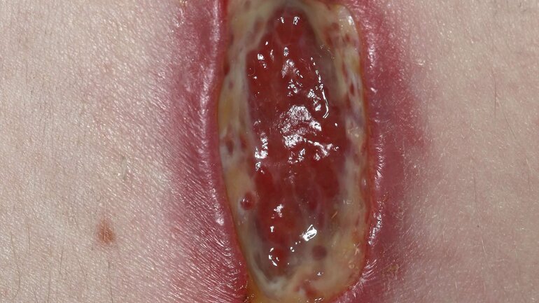 Hautveränderung Ulcus Pyoderma gangraenosum