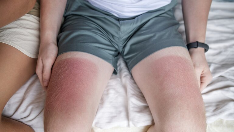 Sonnenbrand homöopathisch behandeln