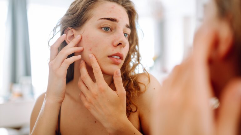 Homöopathie gegen Pickel und Akne