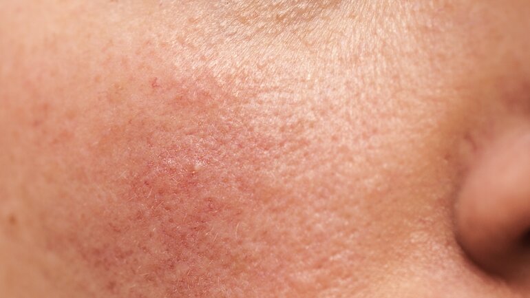Homöopathie bei Couperose und Rosacea