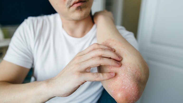 Hautveränderungen können HIV-Symptom sein