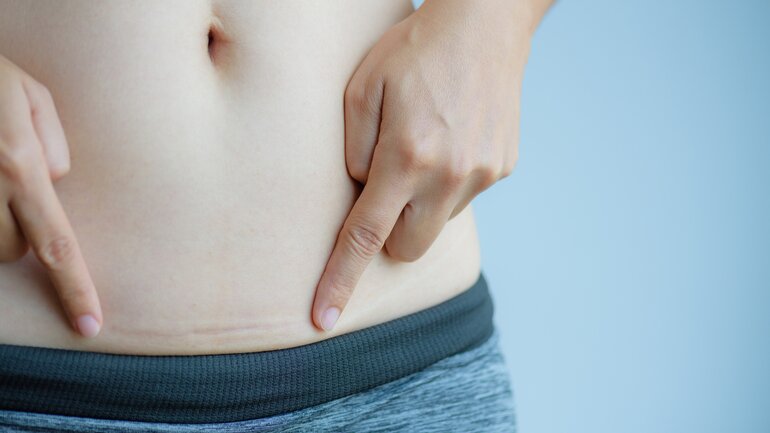 Intimchirurgie: Kaiserschnitt-Narbe korrigieren