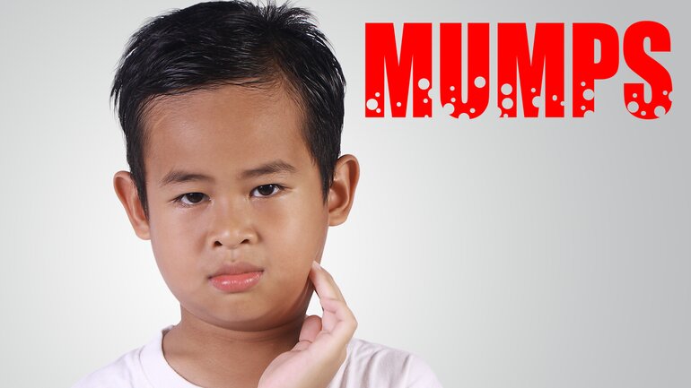 Mumps (auch Ziegenpeter)