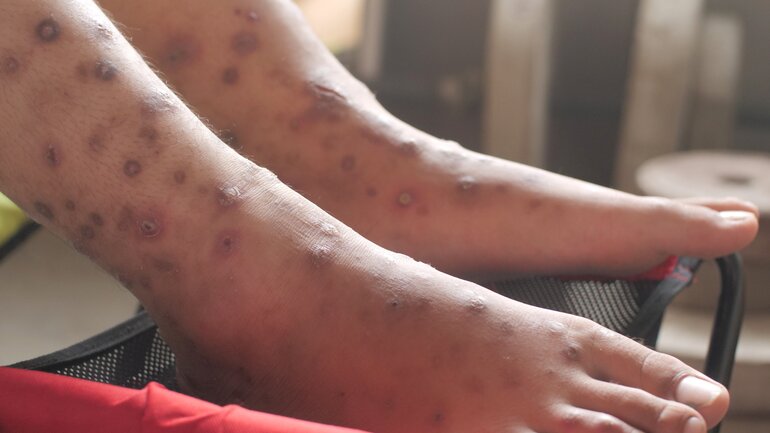 Bild von eitrigem Geschwür durch Krätze-Infektion