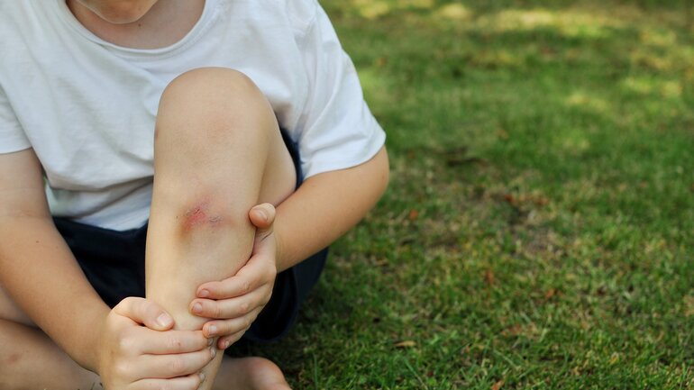Homöopathie für Kinder: Arnica