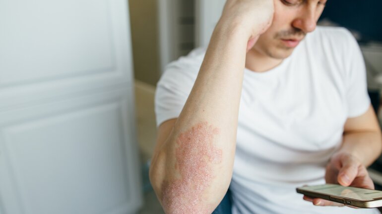 Morbus Crohn: Symptome der Haut