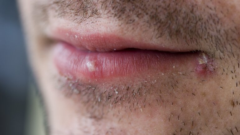 Herpes im oder am Mund