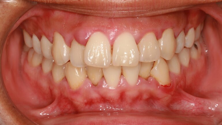 Zahnfleischentzündung (Gingivitis)