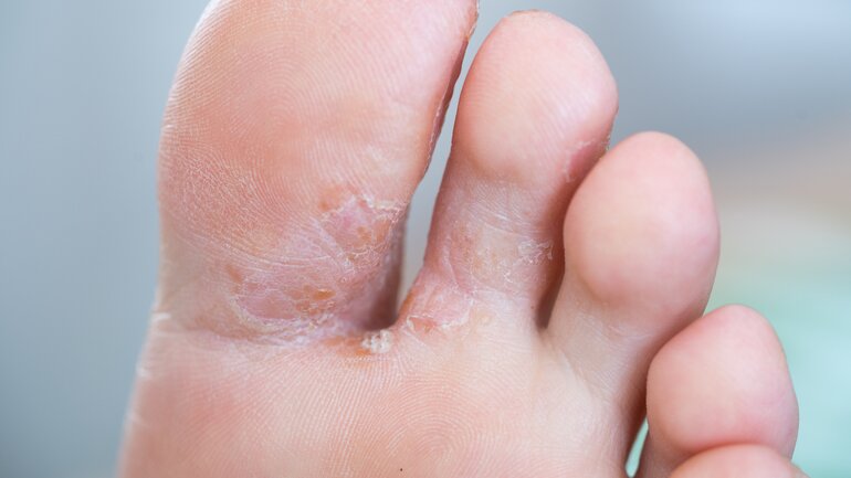 Aus Fußpilz wird irgendwann Nagelpilz
