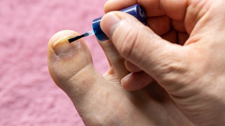 Richtig behandelt, verschwindet Nagelpilz schnell wieder
