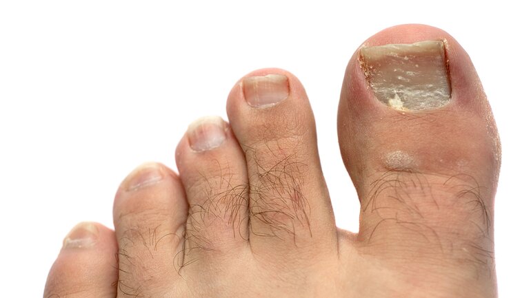 Nagelpilz (Onychomykose)