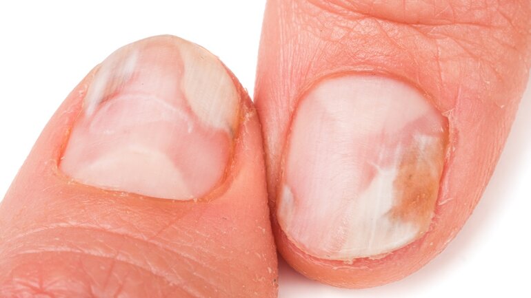 Fortgeschrittener Nagelpilz