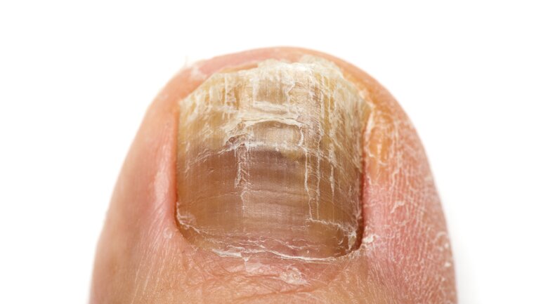Ausgeprägter Nagelpilzbefall