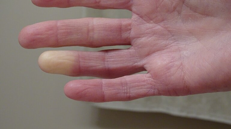 Weiße oder blaue Fingernägel und -kuppen