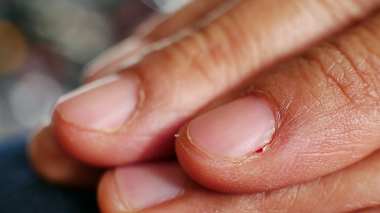 Nagelbettentzündung (Onychie oder Paronychie)
