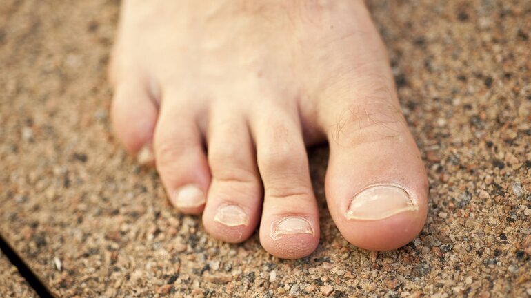 Nagelpilz: Erste Veränderungen erkennen