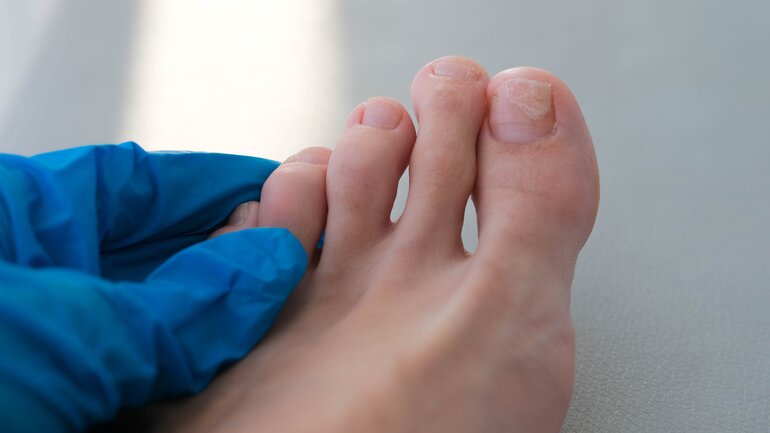 Bild von Nagelpilz am Fuß