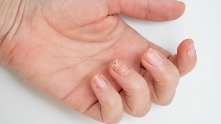 Wie sieht Nagelpilz an den Fingernägeln aus?