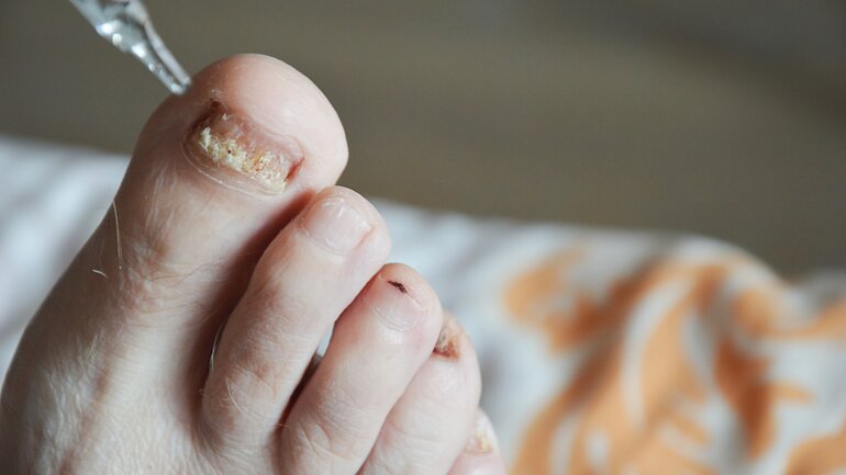 Spätes Nagelpilz-Stadium: Nagelplatte löst sich