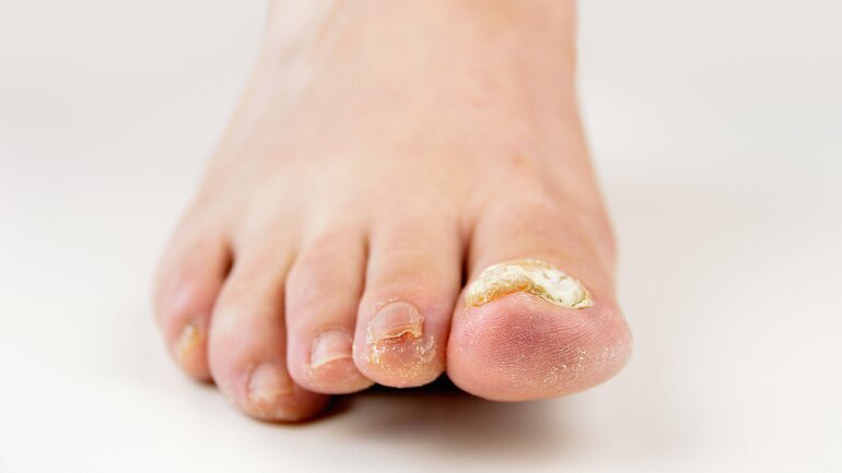 Schmerzen bei Nagelpilzinfektion
