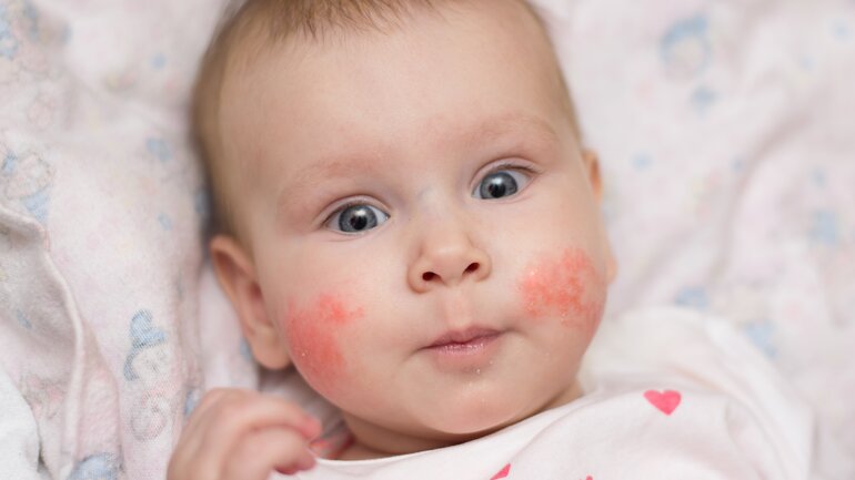 Neurodermitis in Bildern: Bei Babys beginnt es im Gesicht