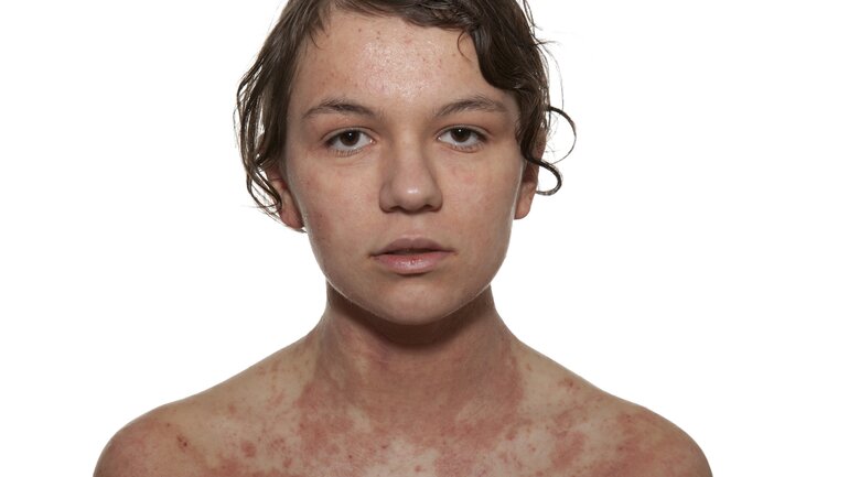 Neurodermitis in Bildern: Lichenifikation