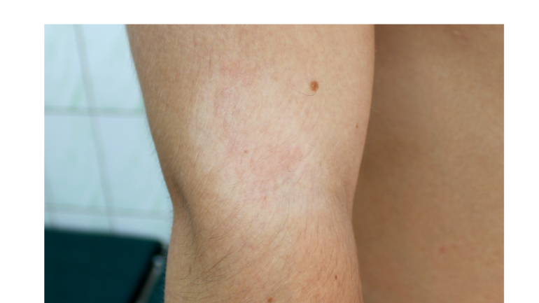Pityriasis alba: weiße Hautflecken