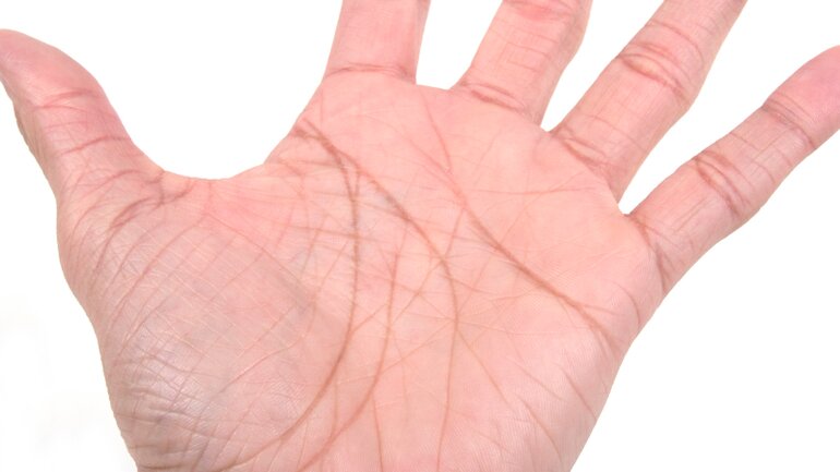 Neurodermitis: Viele Linien in den Handflächen