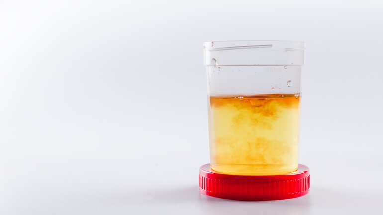 Blut im Urin ist häufig erstes Nierenkrebs-Symptom