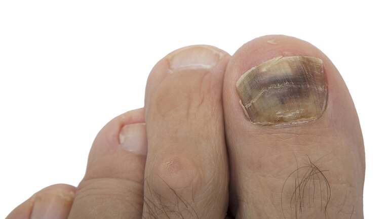 Hautkrebs unter dem Fingernagel