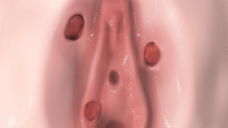 Harter Schanker ist Symptom bei Syphilis