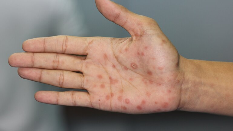 Hautausschlag ist Symptom bei Syphillis