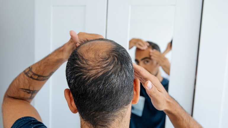 Syphilis: Haarausfall ist Symptom