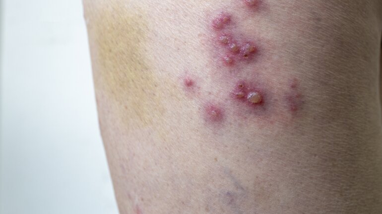 Symptome bei Syphilis: Hautveränderungen