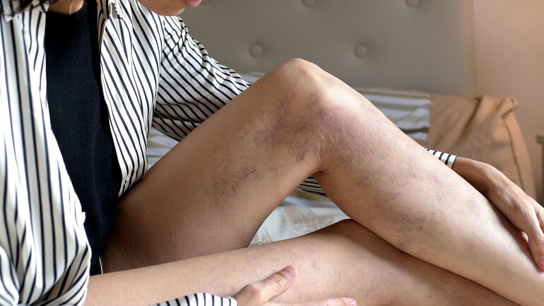 Symptom bei Thrombose: Bläuliche Verfärbungen