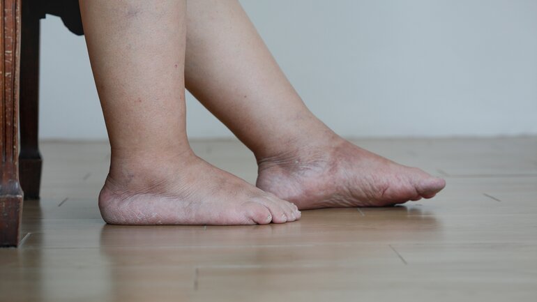 Thrombose im Bein: Schwellungen als Symptom